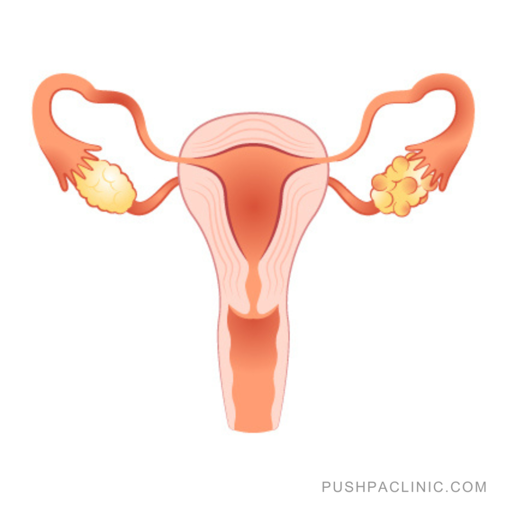 Causes Polycystic Ovarian Disorder