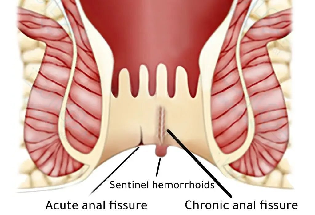 fissure