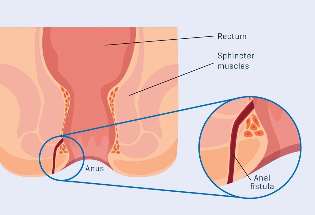 fistula